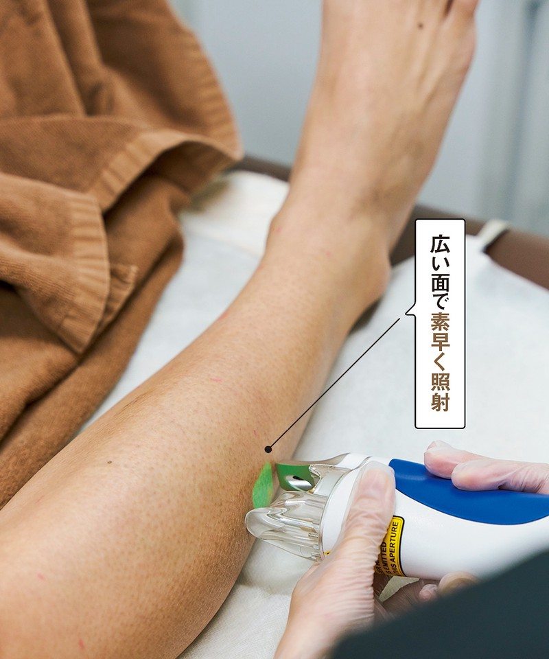 37歳オトコのスネ毛は「医療脱毛」でどうなる!?