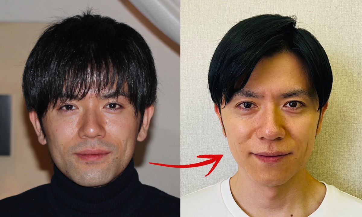 脱毛ビフォー＆アフター。左の脱毛前（30歳）はヒゲを剃っても青ヒゲ状態。脱毛後の右（41歳の現在）はツルツルで肌のコンディションも良好。