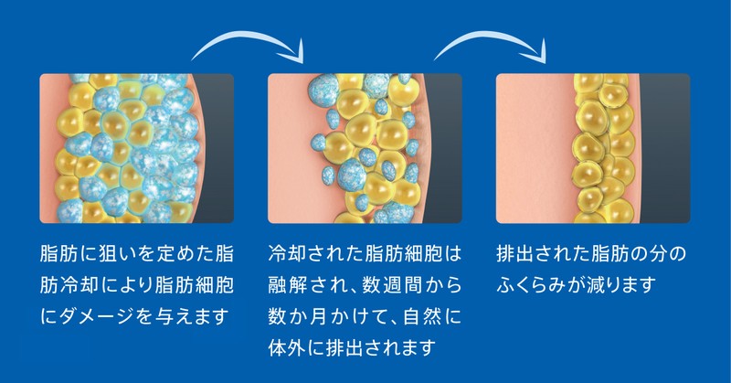 正月太りオヤジ注目! ポッコリお腹は「脂肪冷却治療」で狙い撃ち!?