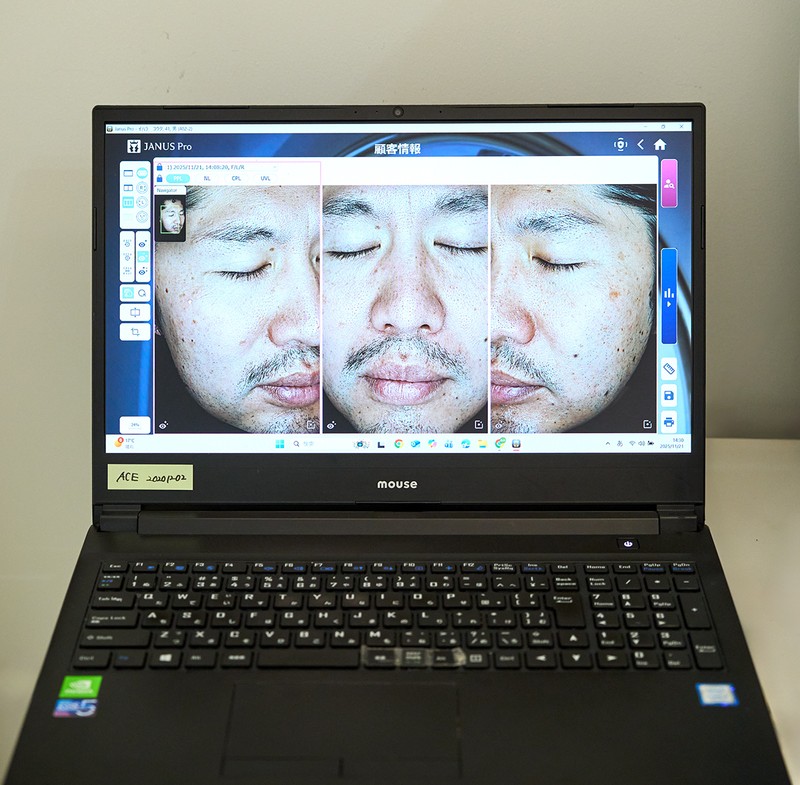 老け見えしていた肌印象を激変させる!?「シミ&ホクロ一掃レーザー」